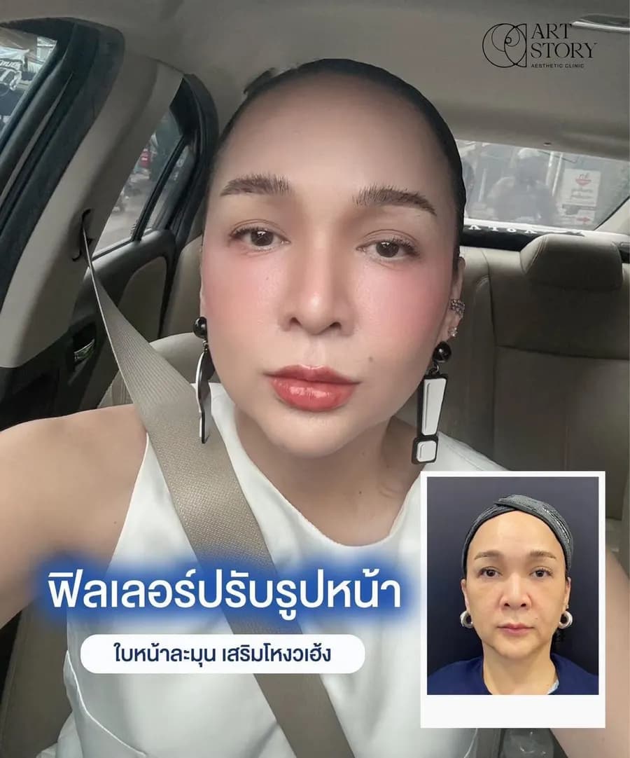 โปรแกรมฟิลเลอร์ปรับรูปหน้า — ภาพก่อนและหลังรับบริการ