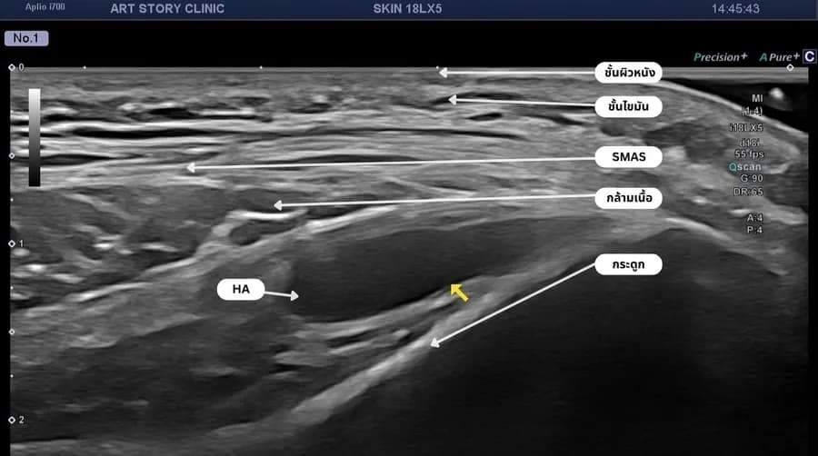 ภาพ Ultrasound แสดงชั้นผิวหนัง ชั้นไขมัน SMAS กล้ามเนื้อ และกระดูก