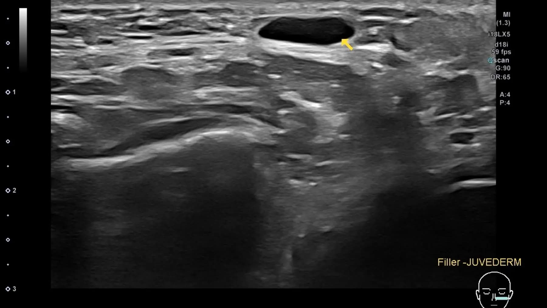 ภาพ Ultrasound แสดงสารเติมเต็มเดิมในชั้นเนื้อเยื่อใต้ผิว