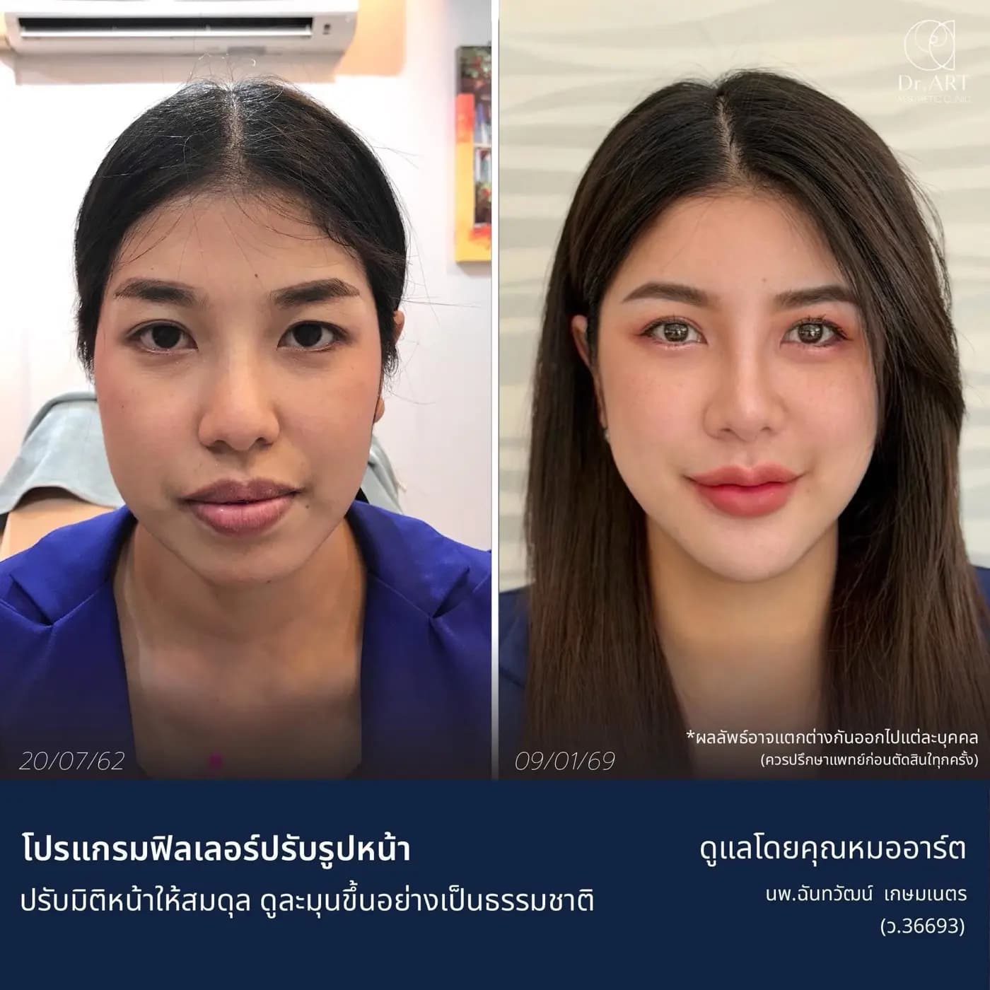 โปรแกรมฟิลเลอร์ปรับรูปหน้า ปรับมิติใบหน้าให้สมดุล — ภาพก่อนและหลังรับบริการ