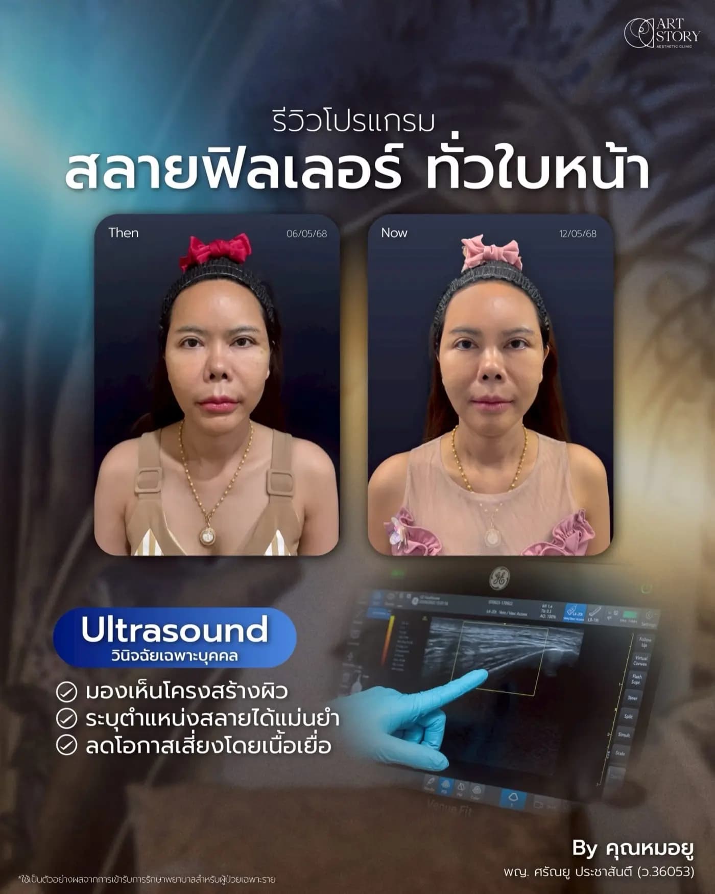 โปรแกรมสลายฟิลเลอร์ทั่วใบหน้า — ภาพก่อนและหลังรับบริการ